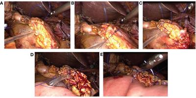 Efficacy of the 'Five-Needle' method for pancreatojejunostomy in laparoscopic pancreaticoduodenectomy: an observational study